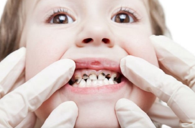 Xarab dişlər insanda hansı xəstəlikləri yaradır? — CAVAB